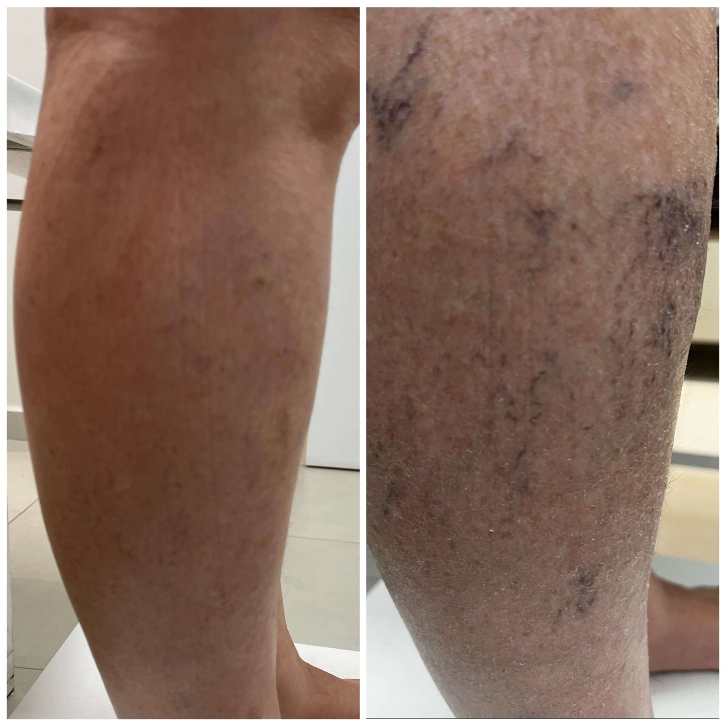 VARICOX VEIN